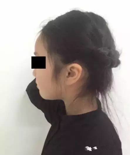 咔嚓一声,10岁女孩的颈椎突然折断了,这件事