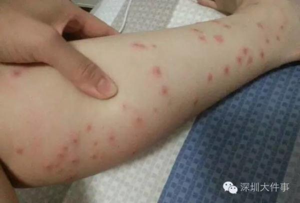 奇痒无比,起包三四天都没消……咬你的可能不是蚊子而是它!杭州也有!