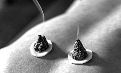 艾灸﹕针所不为 灸之所宜