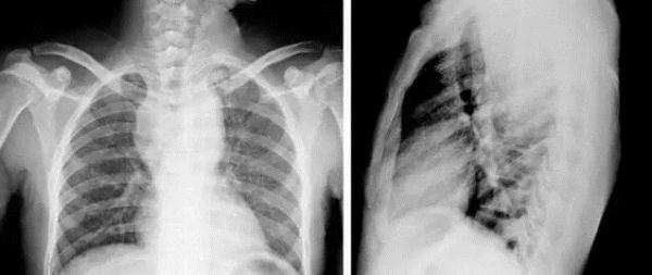 吃什么东西对肺有益 4791982738054136705.jpg