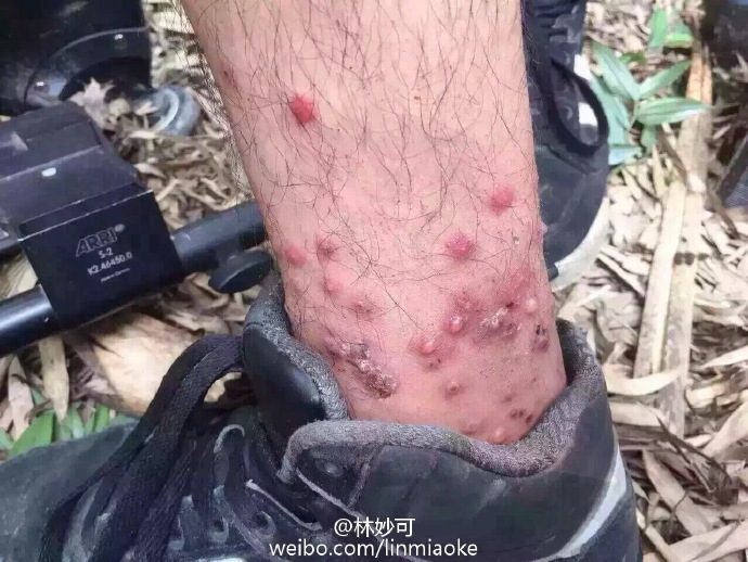 林妙可被毒虫咬伤 林妙可妈妈称看了起鸡皮疙瘩