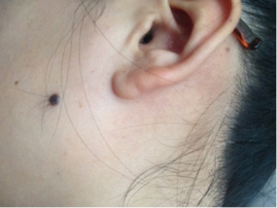 精彩 出现 引起 黑痣 细胞 皮损 皮肤 色素 - 西子客